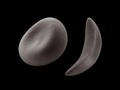 #youtube Malaria and Sickle Cell Anemia — HHMI BioInteractive Video