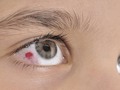 What is a fungal eye infection? - Dr. Sunita Rana Agarwal