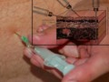 Basic information about intramuscular injection
