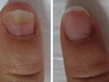 Micosi del piede e delle unghie: quali sono i pericoli che si annidano in questa malattia e quali sono i modi per sbarazzarsene?