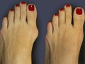 Cum ai putea să scapi de monturi ( Valgus ) singur acasa?