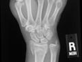 My Broken Wrist Experience