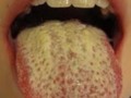 Candid Mouth paint use and side effects
