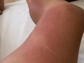 Se olvidó de ponerse protector solar