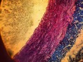 Un tratamiento para el acné podría servir para tratar el endurecimiento de las arterias | Un equipo de científicos del Reino Unido ha identificado el mecanismo responsable del endurecimiento de las arterias y ha demostrado en estudios con animales que un medicamento genérico que se usa normalmente para tratar el acné podría ser un tratamiento eficaz para la enfermedad. El equipo, liderado por la Universidad de Cambridge y el King’s College de Londres, descubrió que una molécula que alguna vez se pensó que solo existía dentro de las células con el propósito de reparar el ADN también es responsable del endurecimiento de las arterias, que se asocia con demencia, enfermedad cardíaca, alta presión arterial y accidente cerebrovascular... Para leer la nota completa entra en ElAcarigueno.com (Foto: Archivo) #Noticias #Salud #Arterias