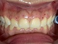 D I S E Ñ O • D E • S O N R I S A • N A T U R A L 🦷   📍  -fase higiénica (limpieza dental profunda)   -Gingivectomia (Recorte de encía) en la cual nos basamos en darle un mejor contorno a sus encías, donde se obtuvo un Excelente resultado.   - Por último se le realizó aclaramiento dental, mejorando el color   -Agenda tu cita 🦷  @alexrey18