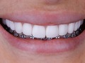 Día 8 de cuarentena, a propósito de un video que andaba rodando por allí, voy a aprovechar para hablar de 10 cosas que tienes que saber sobre las carillas dentales si es que tienes curiosidad sobre el tema, si te las hiciste, o si planeas hacértelas. . 1. “¿Es cierto que todo es un plan macabro de uds los odontólogos para hacer dinero y por eso uds no tienen carillas?” y más cosas absurdas como esa. Si bien es cierto qué hay muchos “profesionales” no capacitados y bastante irresponsables haciendo daño por ahí, no tiene nada que ver una cosa con la otra. Es un tratamiento que tiene sus indicaciones, si no las necesitas el deber de un buen odontólogo es informártelo e instruirte. Además conozco colegas que las tienen.  2. No todos los pacientes son candidatos para carillas dentales, si tu mano funciona bien, ¿por qué poner una mano falsa sobre la tuya natural que está perfectamente funcional? Lo mismo pasa con los dientes. Como cualquier otro tratamiento tiene su indicación.  3. Existen distintos tipos de carillas, unos menos invasivos que otros, en cuanto a materiales, pro, etc. Solamente un odontólogo capacitado en el área puede recomendarte el tipo que se adapte a tus necesidades en caso de que las requieras.  4. Nada dura para siempre dicen por ahí, y las carillas no son para toda la vida, dependiendo del material y la técnica utilizada, con un buen abordaje y un buen pro, es decir un tratamiento bien hecho, el tiempo en óptimas condiciones va a variar entre 7 a 20 años, una carilla hecha con un mal abordaje o un pro deficiente no dura ni un año.  5. ¿Siempre hay que desgastar los dientes para colocar carillas? Todo va a depender del caso, del abordaje que se realice y de las necesidades. No todo tratamiento de carillas lleva involucrado un desgaste dental, hay miles de factores que influyen en esa decisión. Un diente en un estado óptimo no se desgasta porque si.  6. Muchas veces no hay vuelta atrás. Si bien hay tratamientos con carillas que pueden ser provisionales o reversibles, muchas veces por colocarte en manos inexpertas no existe esta posibilidad. Continúa en los comentarios 👇🏻