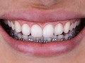 Día 8 de cuarentena, a propósito de un video que andaba rodando por allí, voy a aprovechar para hablar de 10 cosas que tienes que saber sobre las carillas dentales si es que tienes curiosidad sobre el tema, si te las hiciste, o si planeas hacértelas. . 1. “¿Es cierto que todo es un plan macabro de uds los odontólogos para hacer dinero y por eso uds no tienen carillas?” y más cosas absurdas como esa. Si bien es cierto qué hay muchos “profesionales” no capacitados y bastante irresponsables haciendo daño por ahí, no tiene nada que ver una cosa con la otra. Es un tratamiento que tiene sus indicaciones, si no las necesitas el deber de un buen odontólogo es informártelo e instruirte. Además conozco colegas que las tienen.  2. No todos los pacientes son candidatos para carillas dentales, si tu mano funciona bien, ¿por qué poner una mano falsa sobre la tuya natural que está perfectamente funcional? Lo mismo pasa con los dientes. Como cualquier otro tratamiento tiene su indicación.  3. Existen distintos tipos de carillas, unos menos invasivos que otros, en cuanto a materiales, pro, etc. Solamente un odontólogo capacitado en el área puede recomendarte el tipo que se adapte a tus necesidades en caso de que las requieras.  4. Nada dura para siempre dicen por ahí, y las carillas no son para toda la vida, dependiendo del material y la técnica utilizada, con un buen abordaje y un buen pro, es decir un tratamiento bien hecho, el tiempo en óptimas condiciones va a variar entre 7 a 20 años, una carilla hecha con un mal abordaje o un pro deficiente no dura ni un año.  5. ¿Siempre hay que desgastar los dientes para colocar carillas? Todo va a depender del caso, del abordaje que se realice y de las necesidades. No todo tratamiento de carillas lleva involucrado un desgaste dental, hay miles de factores que influyen en esa decisión. Un diente en un estado óptimo no se desgasta porque si.  6. Muchas veces no hay vuelta atrás. Si bien hay tratamientos con carillas que pueden ser provisionales o reversibles, muchas veces por colocarte en manos inexpertas no existe esta posibilidad. Continúa en los comentarios 👇🏻