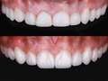 ¿Pero Dra las carillas son malas?  Depende, todo es cuestión de perspectiva.  Este es el mismo paciente, y en ambas fotos tiene un tratamiento de carillas. ¿La diferencia? Planificación, función, biología y estética. En fin, perspectiva. .  #dentalart #prosthodontics #diente #dentalworld #dentistica #dentalcases #DentalPhotography #WaxUp #enceradodiagnostico #incisivoscentrales #dentalart #prosthodontics #diente #dentalworld #dentistica #dentalcases #empressdirect #ivoclarvivadent