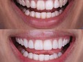 Con cambios pequeños también se logran resultados significativos 🙏🏻 ¿Qué creen que se hizo esta paciente? .  #dentalart #prosthodontics #diente #dentalworld #dentistica #dentalcases #DentalPhotography #WaxUp #enceradodiagnostico #incisivoscentrales #dentalart #prosthodontics #diente #dentalworld #dentistica #dentalcases #empressdirect #ivoclarvivadent