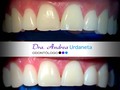 Resultado obtenido con una sesión de Blanqueamiento Pola Office al 35% en el consultorio. ⠀⠀⠀⠀⠀⠀ Cómo tratamiento adicional un día previo al blanqueamiento se regularizaron bordes incisales para crear una sonrisa más estética y armónica. ⠀⠀⠀⠀⠀⠀ El desgaste de bordes incisales puede ser consecuencia de diversos factores, en este caso el paciente padece bruxismo y es su factor #1, para ello se le indicó el uso de una férula nocturna y así controlar el hábito. ⠀⠀⠀⠀⠀⠀ Si el paciente cumple con las indicaciones podrá conservar su sonrisa en excelentes condiciones!. ⠀⠀⠀⠀⠀⠀ Objetivo cumplido ✅ Paciente Feliz✅. ⠀⠀⠀⠀⠀⠀ #dentista #dentistry #odontologia #odontologiaestetica #blanqueamientodental #whitening #saludybienestar #health #pacientesfelices #odontologiapreventiva #caracas .