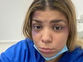 Para conmemorar el día mundial contra la violencia de género, mujeres de MiRed IPS rechazaron todo acto de violencia física o emocional, al reflejar en su cara las secuelas de este tipo de abusos, todas ellas llegaron el día de hoy a trabajar con un “Ojo Morado” con la finalidad que les preguntaran ¿qué pasó?, para poder decir que estamos en contra de la violencia contra las mujeres, que esto es un problema de todos por lo tanto debemos denunciar por las que tiene cautiva su opinión ya sea por miedo o por estar amenazadas.  "Que no se nos vuelva natural la violencia contra las mujeres. La justicia y la equidad de género es una construcción de todos"  #pintatedenaranja #finalaviolencia #nomas #mujeresfuertes #ojomorado #miredips #mired #barranquilla