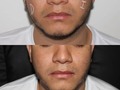 Perfilar el rostro se logra de manera permanente y a ambulatorio los resultados permanentes se ven reflejado a los 3 meses. #barranquilla #valleduparcesar #bucaramangacity #soledad #bodydent_