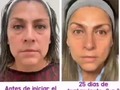 🔅Con nuestro tratamiento obtendrás estos excelentes resultados, verás los cambios desde la primera sesión🤩.  ✔️Eliminas líneas de expresión💕 ✔️Eliminas arrugas 💕 ✔️Eliminas bolsas en los ojos💕 ✔️Tu rostro lucirá más perfilado💕  ✔️Eliminas marcas de acné  ✔️Da luminosidad a tu rostro  ✔️Despigmenta y tonifica el tono  ✔️Remueven las impurezas  ✔️Desvanece cicatrices  ✔️Lucirás hasta 10 años más joven  . . . . #pielsana  #pieldeporcelana  #sinarrugas  #acne  #lineasdeexpresion  #bótox  #limpiezafacial  #rejuvenecer  #antienvejecimiento  #manchasfaciales