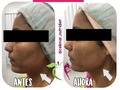 ¿Deseas darle un refrescamiento a tu rostro sin necesidad de recurrir a la cirugía? Atrévete a probar La Radiofrecuencia Facial y cómo mi paciente disfruta de sus beneficios inmediatos. • • Esta técnica es uno de los procesos de rejuvenecimiento facial más avanzado que a través de la transferencia de energía en forma de calor a los estratos más profundos de la dermis, logra la estimulación de la producción de colágeno, eliminando los signos del envejecimiento de la piel y devolviéndole una apariencia juvenil y lozana.💆🏻‍♀️ • • ¿Para que está indicada? ✅Arrugas y líneas de expresión. ✅Papada, mejillas, bolsas y ojeras. ✅Envejecimiento de la piel. ✅Flaccidez y falta de tono en cara y cuello. • • ¿Se requiere reposo tras su aplicación? No es necesario, el paciente puede continuar con su vida normal después de la aplicación ya que no produce dolor, costras ni inflamación. Tampoco está contraindicada la exposición al sol luego del tratamiento siempre que se use el Protector Solar de uso diario. • • ¿Cada cuanto se aplica el tratamiento? Lo recomendado es 1 vez por semana durante 1 mes, posteriormente se pueden aplicar 2 sesiones mensuales por un periodo de 3 meses. • • Agenda tu cita si deseas conocer más sobre este novedoso tratamiento. Contáctame a través del 📱0424-7421052 o a través del DM 📥. • •  #nutricion #salud #nutricionista #sano #saludable #healthy #lifestyle #alimentos #alimento #comida #dieta #dietas #fit #fitness #consultorio #ejercicio #entrenamiento #gym #motivacion #deporte #cardio #vidasana #training #fit #fitnessgirl #salud #belleza #bienestar #valera #trujillo #venezuela