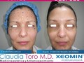 Antes y después de aplicación de toxina botulínica Xeomin con la técnica Grid 21.  Recuerda que @XeominAesthetic es del laboratorio alemán @Merz_Aesthetics, la característica principal de este producto es que una vez que aplicamos produce un efecto de resultado mucho más rápido, en las primeras 24 a 48 horas ya podemos ver gran parte de su resultado y lo más importante es que este producto no genera anticuerpos como otros productos que tenemos en el mercado y al no generar anticuerpos el resultado dura más tiempo en cada paciente.  Si deseas saber cuál es el valor del tratamiento escríbeme al WhatsApp: 📲+57 313 885 3302   Y agenda tu cita de valoración:  Bogotá: ☎+57 (1) 695 4028  Medellín: 📲+57 305 260 8666  #cuidadodelapiel #claudiatoro #lasmejoresmanos #medicinaestetica #belleza #mujerbella #rejuvenecer #medellin #bogota #salud #bienestar #confianza #medicinaesteticamedellin #medicinaesteticabogota #AntesYdespués #AplicaciónToxinaBotulínica #ToxinaBotulínica #Xeomin #TécnicaGrid21 #Grid21 #Merz #LaboratorioAlemán #Resultado #Foto #merzaesthetics #aesthetics