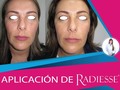 Antes y después aplicación de Radiesse  Radiesse® es un estimulador de colágeno compuesto por hidroxiapatita cálcica, una sustancia que está presente naturalmente en el cuerpo por lo que no produce reacciones alérgicas. Es biocompatible y totalmente degradable.  La eficacia de Radiesse® se basa en la inducción de la generación de nuevo colágeno por nuestro organismo asegurando un efecto de rejuvenecimiento facial de larga duración.  Si deseas saber cuál es el valor del tratamiento escríbeme al WhatsApp: 📲+57 313 885 3302   Y agenda tu cita de valoración:  Bogotá: ☎+57 (1) 695 4028  Medellín: 📲+57 305 260 8666  #cuidadodelapiel #claudiatoro #lasmejoresmanos #medicinaestetica #belleza #mujerbella #rejuvenecer #medellin #bogota #salud #bienestar #confianza #medicinaesteticamedellin #medicinaesteticabogota #AplicaciónRadiesse #AntesYdespués #Radiesse #EstimuladorDeColágeno #Colágeno #Hidroxiapatita #HidroxiapatitaCálcica #RejuvenecimientoFacial