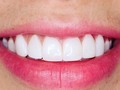 Sonrisas by @Dra.andreav #odontologa #odontologia #estetica #smiledesign #diseñodesonrisa #mujeres #esteticadental #medellin #colombia