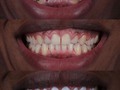 before and after / aesthetic dentistry 💎  we make beautiful smiles, write us and know our plans . 🛩 🇺🇸🇵🇷🇩🇴🇲🇽🇪🇸🇨🇦🇨🇴 Contáctanos @dra.lorenasotob  WhatsApp: +57 314 547 3898 . . #diseñodesonrisa #cosmeticdentistry #smile #smiledesingn #nuevodiseño #esteticadental #porceinervenveners #steticdentistry #calicolombia #diseñodesonrisa #manizales #tumaco #pereira #republicadominicana #santodomingo #ny #miami #miamiflorida #newyork #chile #ecuador #argentina #mexico #smile #smiledesingn #expertaensonrisas #georgia #atlanta