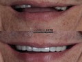 REJUVENECIMIENTO DENTAL  El rejuvenecimiento dental consiste en tratar y restaurar las agresiones provocadas en los dientes y sonrisas a lo largo de los años.  Regresando a tu sonrisa una apariencia mucho más joven  . 🛩 🇺🇸🇵🇷🇩🇴🇲🇽🇪🇸🇨🇦🇨🇴 Contáctanos @dra.lorenasotob  WhatsApp: +57 314 547 3898 . . #diseñodesonrisa #cosmeticdentistry #smile #smiledesingn #nuevodiseño #esteticadental #porceinervenveners #steticdentistry #calicolombia #diseñodesonrisa #manizales #tumaco #pereira #republicadominicana #santodomingo #ny #miami #miamiflorida #newyork #chile #ecuador #argentina #mexico #smile #smiledesingn #expertaensonrisas #georgia #atlanta