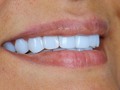 Smile design resin 💯  @dra.lorenasotob Aesthetic dentistry  🛩 🇺🇸🇨🇴   schedule your assessment appointment Contáctanos @dra.lorenasotob  WhatsApp: +57 314 547 3898 . . #diseñodesonrisa #cosmeticdentistry #smile #smiledesingn #esteticadental #porceinervenveners #steticdentistry #diseñodesonrisa #mexico #miamiflorida #newyork #canada #republicadominicana #santodomingo #smiledesingn  #expertaensonrisas #georgia #atlanta