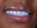 Smile design porcelain veneers 💯  @dra.lorenasotob Aesthetic dentistry  🛩 🇺🇸 🇵🇷 🇩🇴 🇨🇦 🇪🇸 🇨🇴   schedule your assessment appointment Contáctanos @dra.lorenasotob  WhatsApp: +57 314 547 3898 . . #diseñodesonrisa #cosmeticdentistry #smile #smiledesingn #esteticadental #porceinervenveners #steticdentistry #diseñodesonrisa #mexico #miamiflorida #newyork #canada #republicadominicana #santodomingo #smiledesingn  #expertaensonrisas #georgia #atlanta