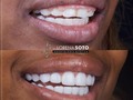 Resin smile design 💎  🛩 🇺🇸🇨🇴  Contáct: @dra.lorenasotob  WhatsApp: +57 314 547 3898 . . #diseñodesonrisa #cosmeticdentistry #smile #smiledesingn #nuevodiseño #esteticadental #porceinervenveners #steticdentistry #calicolombia #diseñodesonrisa #manizales #tumaco #boston #nuevajersey #republicadominicana #santodomingo #ny #miami #miamiflorida #newyork #chicago #losangeles #argentina #mexico #smile #smiledesingn #expertaensonrisas #georgia #atlanta