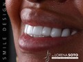 Smile design 💎  🛩 🇺🇸🇨🇴  Contáct: @dra.lorenasotob  WhatsApp: +57 314 547 3898 . . #diseñodesonrisa #cosmeticdentistry #smile #smiledesingn #nuevodiseño #esteticadental #porceinervenveners #steticdentistry #calicolombia #diseñodesonrisa #manizales #tumaco #boston #nuevajersey #republicadominicana #santodomingo #ny #miami #miamiflorida #newyork #chicago #losangeles #argentina #mexico #smile #smiledesingn #expertaensonrisas #georgia #atlanta #texas #españa