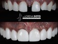 Smile design 💎 Dra. Lorena Soto  🛩 🇺🇸🇨🇴  Contáct: @dra.lorenasotob  WhatsApp: +57 314 547 3898 . . #diseñodesonrisa #cosmeticdentistry #smile #smiledesingn #nuevodiseño #esteticadental #porceinervenveners #steticdentistry #calicolombia #diseñodesonrisa #manizales #tumaco #boston #nuevajersey #republicadominicana #santodomingo #ny #miami #miamiflorida #newyork #chicago #losangeles #argentina #mexico #smile #smiledesingn #expertaensonrisas #georgia #atlanta #texas #Michigan