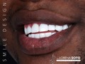 Smile design 💎 Dra. Lorena Soto  🛩 🇺🇸🇨🇴  Contáct: @dra.lorenasotob  WhatsApp: +57 314 547 3898 . . #diseñodesonrisa #cosmeticdentistry #nuevodiseño #esteticadental #porceinervenveners #steticdentistry #calicolombia #diseñodesonrisa #manizales #tumaco #boston #nuevajersey #republicadominicana #santodomingo #ny #miami #miamiflorida #newyork #chicago #losangeles #argentina #mexico #smile #smiledesingn #expertaensonrisas #georgia #atlanta #texas #usa