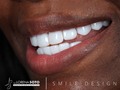 😀   Smile design 💎 Dra. Lorena Soto  @firstclasstaxandconsulting @coach_jaymar   🛩 🇺🇸🇨🇴  Contáct: @dra.lorenasotob  WhatsApp: +57 314 547 3898 . . #diseñodesonrisa #cosmeticdentistry #smile #smiledesingn #nuevodiseño #esteticadental #porceinervenveners #steticdentistry #calicolombia #diseñodesonrisa #manizales #tumaco #boston #nuevajersey #republicadominicana #santodomingo #ny #miami #miamiflorida #newyork #chicago #losangeles #argentina #mexico #georgia #atlanta #texas #michigan