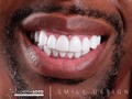 Una sonrisa hermosa es una tarjeta de presentación que nunca pasa de moda. En nuestro centro de estética dental, te ayudamos a alcanzar una sonrisa radiante y saludable. ¡No esperes más y programa una consulta con nuestros especialistas hoy mismo!  A beautiful smile is a business card that never goes out of style. At our dental aesthetics center, we help you achieve a radiant and healthy smile. ¡Don't wait any longer and schedule a consultation with our specialists today!  @dra.lorenasotob Aesthetic dentistry  🛩 🇺🇸🇨🇴   schedule your assessment appointment Contáctanos @dra.lorenasotob  WhatsApp: +57 314 547 3898 . . #diseñodesonrisa #cosmeticdentistry #smile #smiledesingn #esteticadental #porceinervenveners #steticdentistry #diseñodesonrisa #mexico #miamiflorida #newyork #canada #republicadominicana #santodomingo #smiledesingn  #expertaensonrisas #georgia #atlanta #esteticadental #sonrisaradiante