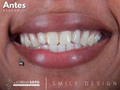 Schedule your assessment appointment in aesthetic dentistry and live this beautiful experience  @dra.lorenasotob Aesthetic dentistry 🛩 🇺🇸🇨🇴  schedule your assessment appointment Contáctanos @dra.lorenasotob  WhatsApp: +57 314 547 3898 . . #diseñodesonrisa #cosmeticdentistry #smile #smiledesingn #esteticadental #porceinervenveners #steticdentistry #mexico #miamiflorida #newyork #canada #republicadominicana #santodomingo #expertaensonrisas #georgia #atlanta #sonrisaradiante #confianzaencadasonrisa #CuidadoDental #transformación#antesydespués