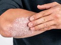 Los receptores CB1 alivianlos síntomas causados por enfermedades inflamatorias de la piel, como la #Psoriasis. En este caso, el CBD tópico ayuda a: - Desinflamar e hidratar - Desinfectar - Regenerar la piel - Regular la hiperprofiliferación de queratinocitos en la piel.