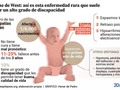 Síndrome de #West Es un tipo de #epilepsia grave, que aparece con más frecuencia entre los 3 y los 12 meses de vida. Puede ser debido a diferentes causas como las malformaciones cerebrales o #displasias, infecciones, alteraciones metabólicas, origen genético. Cursa con la presencia de crisis comiciales con contracciones bruscas y simétricas de las extremidades, pudiendo cursar con flexión o extensión de los miembros. También en ocasiones hay enrojecimiento facial, dilatación pupilar o midriasis e hipersudoración. Esta enfermedad cursa también con retraso psicomotriz, que afecta la esfera cognitiva, su interacción con el entorno y su movilidad. En el #electroencefalograma o EEG aparece un registro específico llamado hipsarritmia. Su tratamiento consiste en antiepilép, #benzodiacepinas, vitamina B6, cor, etc. La mortalidad está en el 5 % de los pacientes.