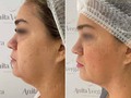 👩🏻‍⚕ Procedimiento: Perfilamiento Facial. Cirugía mínimamente invasiva. 🎯 Propósito: Remodelar y perfilar el contorno facial. ♥️ Beneficios: Rostro más definido, piel tersa y suave, retrasa las señales de envejecimiento. ¡Sin cicatrices! 😴 Anestesia: Local. 🕑 Tiempo: 40 minutos aproximadamente. 💲Precio: Sujeto a valoración. 💬 Nota: Es necesario agendar cita de valoración. 📞 Whatsapp: (+57) 310 347 9699. ☎ Teléfonos: 3851971 - 3861956. 📍Ubicación: Calle 85 # 47-61, edificio Jacur 85, local 3, Barranquilla. ⏰ Horarios de atención: Lunes a viernes: 8 AM - 12 PM / 2 PM - 6 PM, Sábados: 8 AM - 2 PM. Domingos y festivos: cerrado.  #lipolaser #antesydespues #papada #perfilamientofacial #bellezainfinita #rostrohollywood #barranquill