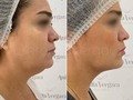 👩🏻‍⚕ Procedimiento: Perfilamiento Facial. Cirugía mínimamente invasiva. 🎯 Propósito: Remodelar y perfilar el contorno facial. ♥️ Beneficios: Rostro más definido, piel tersa y suave, retrasa las señales de envejecimiento. ¡Sin cicatrices! 😴 Anestesia: Local. 🕑 Tiempo: 40 minutos aproximadamente. 💲Precio: Sujeto a valoración. 💬 Nota: Es necesario agendar cita de valoración. 📞 Whatsapp: (+57) 310 347 9699. ☎ Teléfonos: 3851971 - 3861956. 📍Ubicación: Calle 85 # 47-61, edificio Jacur 85, local 3, Barranquilla. ⏰ Horarios de atención: Lunes a viernes: 8 AM - 12 PM / 2 PM - 6 PM, Sábados: 8 AM - 2 PM. Domingos y festivos: cerrado.  #lipolaser #antesydespues #papada #perfilamientofacial #bellezainfinita #rostrohollywood #barranquill