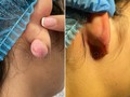 👩🏻‍⚕️🗯️ Queloide es una cicatriz levantada que se produce después de la cicatrización de una herida. Se forma tejido grueso que sobresale de la zona que se está sanando. Se vuelven más grandes con el tiempo y usualmente vuelven a formarse después de ser tratados. . . En este caso, fue ocasionado por un piercing en la oreja. En el procedimiento se retiró, se resecó el tejido y luego se realizó una Lobuloplastia con el fin de no dejar tejido enfermo y evitar que vuelva a salir. Esto apenas es el comienzo, ahora empieza lo más importante que es el pro que nosotros empleamos en este tipo de pacientes durante 6 a 8 meses. El verdadero éxito se da en el cuidado posterior por medio de diferentes tipos de tratamientos para evitar que vuelva a salir. #casosdranita #casosespecialesdranita #ladoctoradelasestrellas #queloide #medicinaestetica #antesydespues #piercingnariz