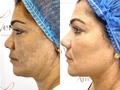 ❌➡️NO es Photoshop, es la magia de la #Bellezainifinita y nuestro ritual @avevcosmetics ✅ es un resultado Real, sin ediciones ni filtros. Cuando una paciente es juiciosa, ayuda a que los resultados sean siempre mejor.  👩🏻‍⚕️Procedimientos: ⚡️Pro despigmentante. 🪄Perfilamiento facial( Endolifting láser)  🧚‍♂️Reposición de grasa facial con hilos tensores. ⭐️Botox 👃🏼Rinomodelacion  👀Filler Ojeras. ✨ Resultados en tan solo 2 meses. #rostrohollywood #sevalesoñar #tratamientointegralfacial #unapacientefeliz