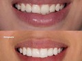 ✅¿Del 1 al 10 cuánto te encanta la naturalidad de la #sonrisainfinita? ⭐️✨   •👩🏻‍⚕️Procedimientos: Aclaramiento dental + micro diseño ( Bordes en resina compuesta de alta estética) 🔥 @dra.sussmann  #bellezainfinita #rostrohollywood #sevalesoñar