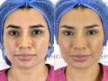 ¿Qué tal este resultado?🤯 ✅Cuenta la leyenda que si comentas aquí!⬇️ el procedimiento de tus sueños se hará ¡REALIDAD!  👩🏻‍⚕️Procedimientos: ✅Fox eyes: consisten en el levantamiento de cejas a través de hilos PDO por debajo de la piel, creando un efecto lifting en la zona. Dan como resultado una “mirada de modelo”. ✅Botox: ayuda a suavizar la mirada, rejuvenecer el rostro e impedir la formación de más arrugas. ✅Filler ojeras: hidrata profundamente la piel y mejora la coloración oscura. Se obtiene como resultado una mirada más fresca, descansada y juvenil. ✅Además tratamos la piel con higiene + Plasma + black peel, y nuestros productos Estrella ( Protector solar, cream tonic ) @avevcosmetics 💖 para mejorar la textura y manchitas del rostro.  #thedoctorofthestars #LaDoctoraDeLasEstrellas #avevcosmetics #sevalesoñar