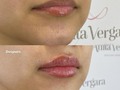 ✨Arriba la mano ☝🏻quien quiere unos labios by @dranitavergara 💕 • • 👩🏻‍⚕️Procedimientos:  ✅ Hidratación de labios: Ayuda a eliminar las arrugas finas, mejorar la estructura y la elasticidad de la piel sin aumentar su volumen.  ✅Los resultados son inmediatos y tienen una duración de aproximadamente 1 año.  ✅Tecnica especial @dranitavergara a con Acido hialuronico. #bellezainfinita #ladoctoradelasestrellas