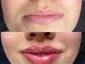 RUSSIAN LIPS 🫦🔥 ¡Los quieres y los necesitas! 🙌🏻  Técnica especial @dranitavergara  💉 Ácido hialuronico.  #Thedoctorofthestars #LaDoctoraDeLasEstrellas #russianlips #bellezainfinita #sevalesoñar