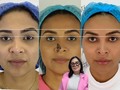 🌟 Botox: ¡No solo para arrugas!   ¿Sabías que el Botox puede hacer mucho más que suavizar las líneas de expresión? ¡también nos ayuda a corregir asimetrías! 💉💕  Descubre el poder transformador del Botox para lograr equilibrio y armonía facial. ¡Agenda tu consulta y descubre el poder de la #BellezaInfinita  ————————————————— 🌟 Botox: Not just for wrinkles!  Did you know that Botox can do much more than just smooth out expression lines? It also helps us correct asymmetries! 💉💕  Discover the transformative power of Botox to achieve facial balance and harmony. Schedule your consultation and uncover the power of #InfiniteBeauty.  📲 + 57 (310) 347-9699  📍Calle 86 #47 - 81 - Barranquilla,Colombia. 💻   #InfiniteBeauty #RostroHollywood #BellezaInfinita #RostroHollywood