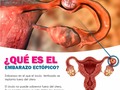 ✔️👨🏻‍⚕️Un embarazo ectópico se produce cuando el feto se desarrolla fuera del útero y da lugar a una gestación que físicamente no puede progresar. Es una situación que puede ser muy peligrosa para la mujer.  Este se produce Inmediatamente después de que el espermatozoide fecunde al óvulo, hecho que se produce en la trompa de Falopio -en el área más ancha y cercana al ovario  ‼️Los embarazos ectópicos pueden anidar muy raramente en otras zonas diferentes a la trompa de Falopio:  - el cuello del útero o cérvix,  - los cuernos uterinos (donde el embrión no puede desarrollarse bien),  -en el ovario -en espacios abdominales  -incluso en el hígado. Todas estas implantaciones están abocadas al fracaso.‼️  Pero conviene tener presente que al principio, la mujer no notará síntomas de embarazo ectópico, y que solo se detecta si le realizan una ecografía‼️
