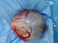 El día de hoy se hizo una extracción de un quiste en el ovario izquierdo, este tenía un peso de 450gr ✔️  Logramos salvar el ovario 💯