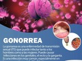 Los síntomas incluyen micción dolorosa y excreciones anormales del pene o la vagina. Los hombres sienten dolor en los testículos y las mujeres pueden sentir dolor en la zona inferior del vientre. En algunos casos, la gonorrea no presenta síntomas.  La gonorrea se puede curar con el tratamiento correcto. Es importante que tome todos los medicamentos que su médico le recete para curar su infección.