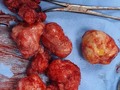 Paciente de 32 años con diagnóstico de Miomatosis Uterina que tiene una infertilidad por ese motivo y para preservar su utero y buscando un futuro embarazo se le realiza una laparotomia ginecologica realizándose múltiples miomectomias con preservación de el utero buscando preservar e intentar su capacidad de embararazarse✅