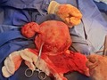 Los fibromas uterinos son tumores no cancerosos del útero que a menudo aparecen durante los años fértiles   Los fibromas son formados por células musculares y otros tejidos que crecen en y alrededor de las paredes del útero Se desconoce su causa