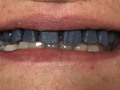 Este ha sido uno de los casos más complejos atendido por nosotros. Rehabilitación sobre implantes, con mucho éxito! 🔜Pronto fotos del caso finalizado...